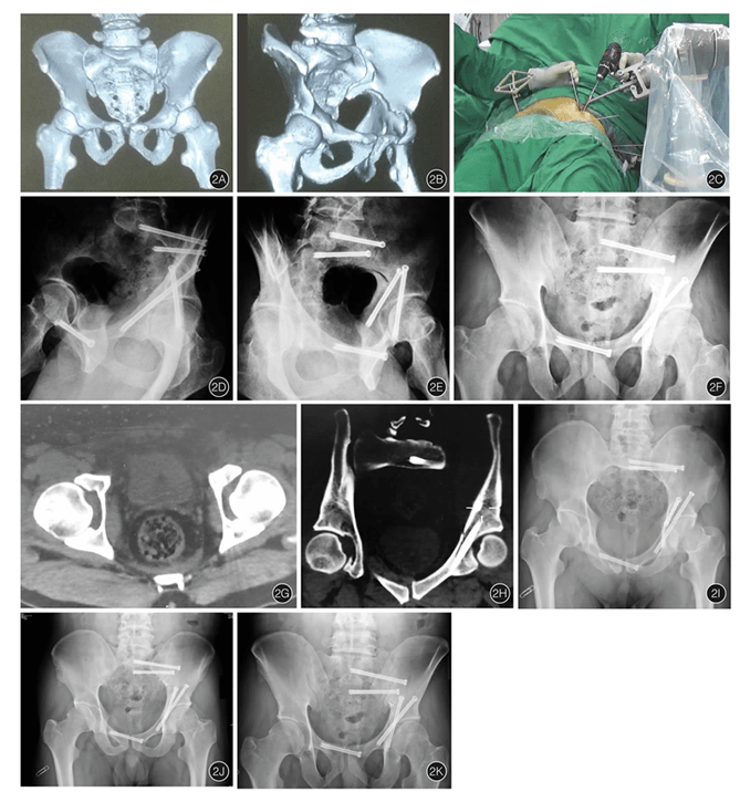 春立医疗：髋关节手术机器人等产品获注册证
