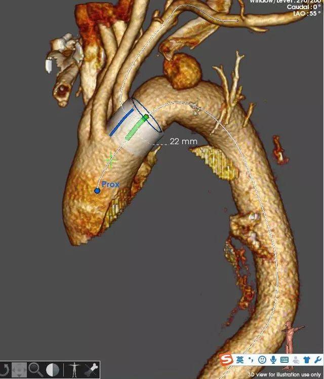 心脉医疗最新公告：Hector®/通天戟?胸主动脉多分支覆膜支架系统获美国FDA突破性医疗器械认定
